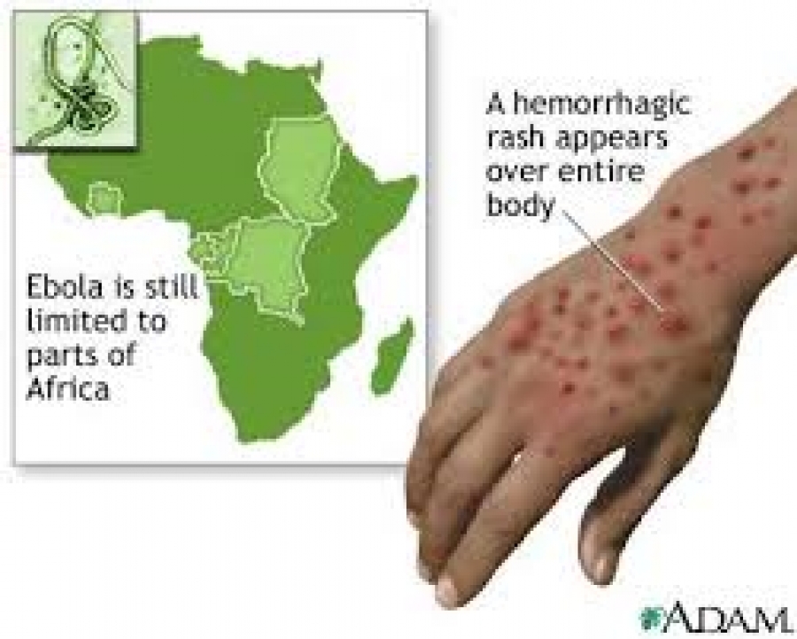 Ebola virus disease (Λοίμωξη από τον ιό Έμπολα)