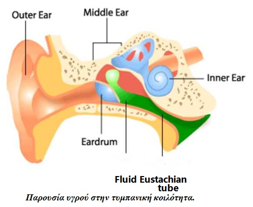 Υγρό στο αυτί (μέση εκκριτική ωτίτιδα)