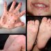 Νόσος χεριών-ποδιών-στόματος (Hand-foot-mouth disease)  Copy